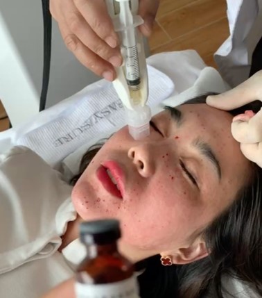 What is Mesotherapy